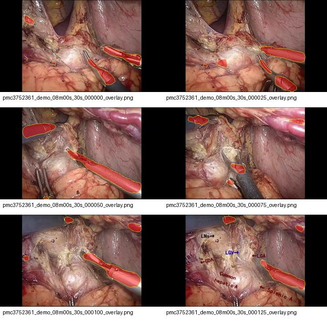 Contact sheet showing preliminary instrument-overlay predictions on public laparoscopic gastrectomy frames.