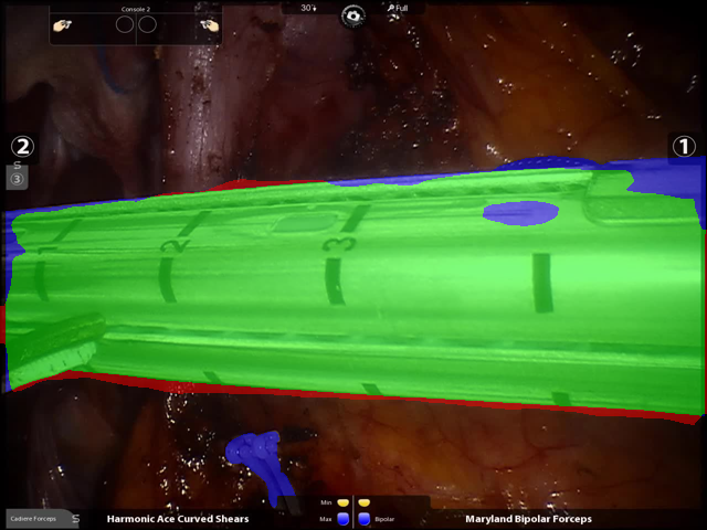 Fine-tuned SISVSE Run B success overlay example with IoU 0.902 on a public robotic gastrectomy frame.
