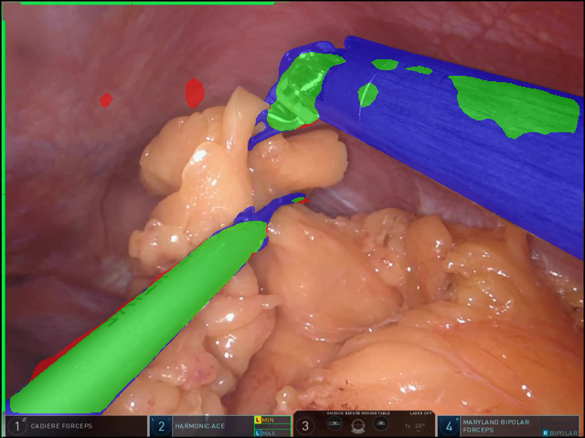 Fine-tuned SISVSE Run B typical overlay example with IoU 0.462 on a public robotic gastrectomy frame.